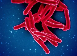 Người nhiễm HIV cần làm gì để phòng tránh lao tái phát?
