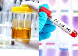 5 dấu hiệu cảnh báo axit uric cao và sỏi thận, phòng ngừa như thế nào?