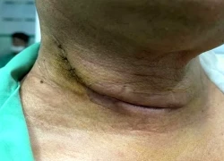 Phát hiện mắc cùng lúc 2 loại ung thư sau 6 tháng khàn tiếng