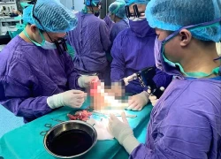 Phẫu thuật cứu chân đứt lìa cho nữ sinh sau tai nạn ở Hà Nội