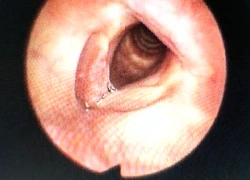 TPHCM: Phát hiện ca bệnh hiếm gặp, mắc cùng lúc 2 loại ung thư