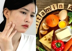 Các loại thực phẩm bổ sung quá mức gây hại cho làn da