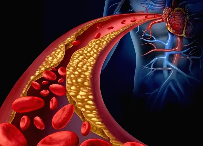 Tăng lipid máu dễ gây đột quỵ