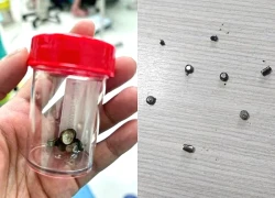 Bé trai 4 tuổi nuốt 10 cục pin và nam châm gây thủng ruột