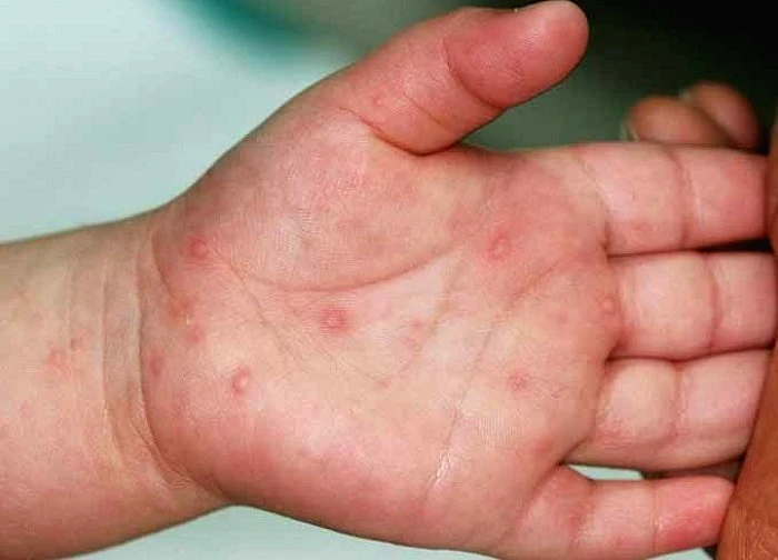 Bệnh tay chân miệng ở trẻ em: Dấu hiệu, nguyên nhân và cách điều trị