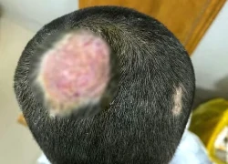 Cậu bé 6 tuổi hói vĩnh viễn vì nuôi thú cưng