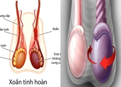 Đột ngột đau dữ dội vùng bìu, chàng trai 20 tuổi may mắn giữ được tinh hoàn