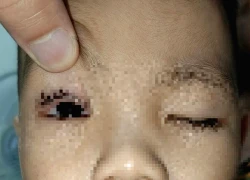 Bé 2 tuổi bị pháo hoa bắn trúng mắt khi xem Trung thu