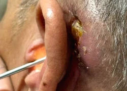 Loại bỏ khối u chung sống 10 năm gây liệt mặt
