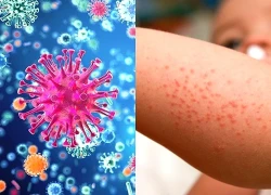 Tăng ca viêm màng não do não mô cầu, 82 người mắc trong 9 tháng