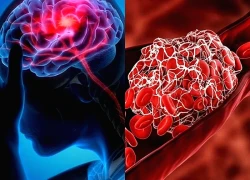 Hơn 99% các cơn đột quỵ và nhồi máu cơ tim liên quan 4 điều này