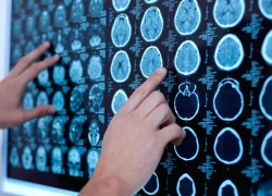 Trung Quốc thử nghiệm lâm sàng giai đoạn 3 thuốc điều trị ung thư não