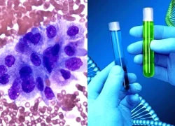 Ung thư dịch màng: bước tiến mới trong chẩn đoán ung thư không cần sinh thiết