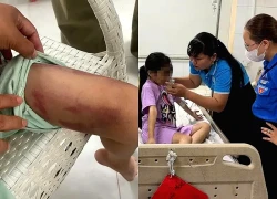 Bé gái 9 tuổi ở TPHCM bị 'chồng hờ' của mẹ đánh nhập viện