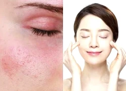 Làm đẹp bằng nước đá: Lợi ích và rủi ro cần lưu ý cho làn da