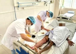 Giữ thang giúp hàng xóm, người đàn ông nhập viện với 30% cơ thể bỏng rộp
