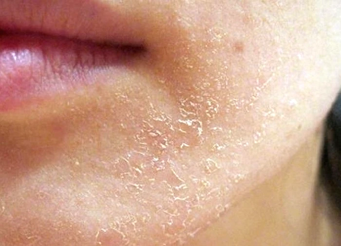 5 cách đơn giản tạm biệt khô da mùa hanh