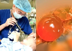 Bé trai 14 tháng tuổi nôn nhiều, bố mẹ bất ngờ khi bác sĩ gắp ra thứ 'đáng sợ' trong bụng