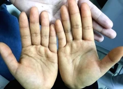 Dấu hiệu cảnh báo viêm gan B giai đoạn đầu