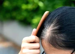 Thực phẩm quen thuộc gây bạc tóc, hói đầu sớm