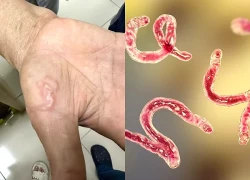 Biểu hiện mắc giun sán cần đi khám sớm, khám ở đâu?