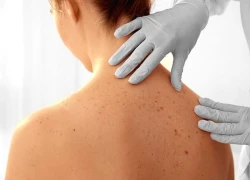 Người phụ nữ 45 tuổi phát hiện bị ung thư da từ một dấu hiệu trên mí mắt, rất dễ bị bỏ qua