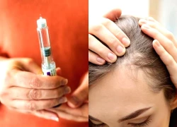 Thuốc giảm cân GLP-1 có nguy cơ gây rụng tóc?