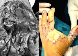 Dập nát bàn tay vì máy băm sắn