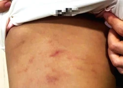 Bé gái 2 tuổi có dấu hiệu bị bạo hành ở nhóm trẻ tư thục