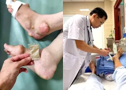 Nhiều người 'tiền mất, tật mang' vì mua thuốc ngoài chợ, trên mạng trị gout