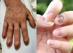 6 dấu hiệu ở móng tay cảnh báo nguy cơ mắc bệnh nguy hiểm