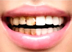 Lợi ích khi lấy cao răng, khi nào không nên lấy cao răng?