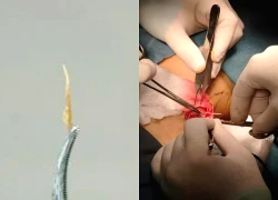 Suýt thủng phế quản vì... mảnh xương cá 'đi lạc' suốt 3 tuần trong phổi