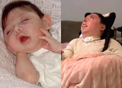Cô bé sinh ra không có não bây giờ ra sao?