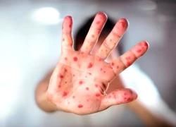 Dịch sởi bùng phát trở lại tại Canada