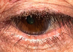 Ngứa mắt dai dẳng, cảnh báo rận mu 'làm tổ' quanh chân lông mi