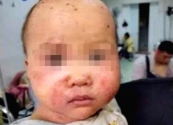 Trẻ 10 tháng tuổi nguy kịch do bố mẹ tự ý dùng thuốc điều trị mắt