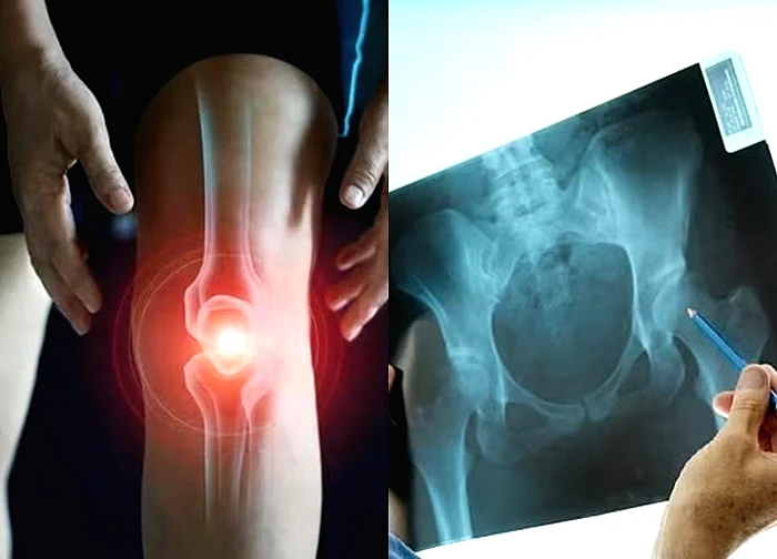 4 loại thực phẩm âm thầm làm tăng nguy cơ loãng xương