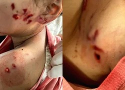 Bé 6 tuổi chấn thương nghiêm trọng do chó nhà 20 kg tấn công