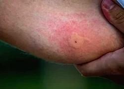 Cúm mùa gia tăng, dịch sốt xuất huyết vào cao điểm