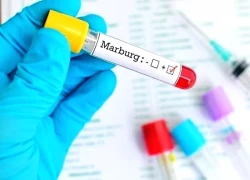 Ethiopia xác nhận sự bùng phát của virus Marbug gây chết người