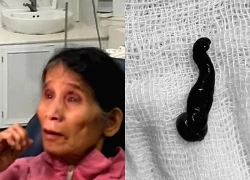 Ớn lạnh cảnh con đỉa sống trong mũi người phụ nữ suốt 3 tuần