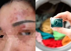 Bỏng giác mạc chỉ vì bất cẩn khi giặt đồ