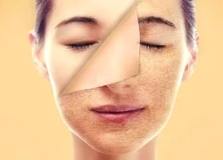 Cách chăm sóc da mùa đông phòng nứt nẻ