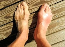 Dấu hiệu cảnh báo nồng độ axit uric tăng cao