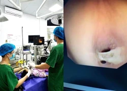 Nhiều trẻ bị tổn thương đường thở do hóc dị vật