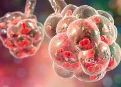 Phế cầu khuẩn gây ra nhiều bệnh nguy hiểm