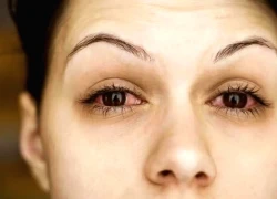 Triệu chứng của thận yếu biểu hiện ở mắt