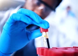 Xét nghiệm máu chích đầu ngón tay có thể phát hiện bệnh trước 10 năm