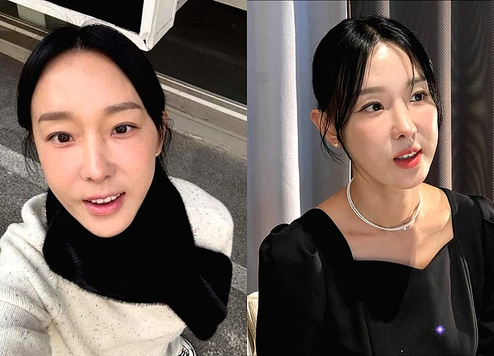 Mỹ nhân phim giờ vàng liều lĩnh "dao kéo" thu ngắn nhân trung, giờ gánh di chứng đến suốt đời